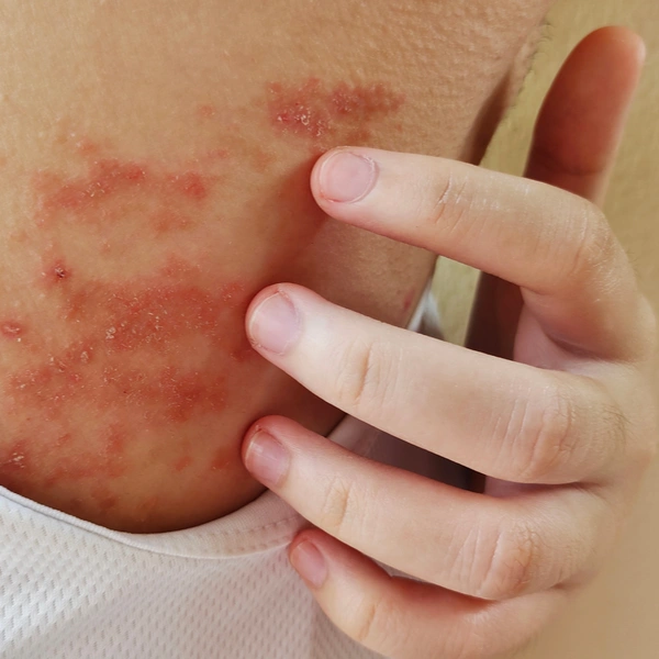 Niño con alergia
