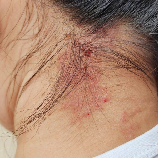 Niño con alergia
