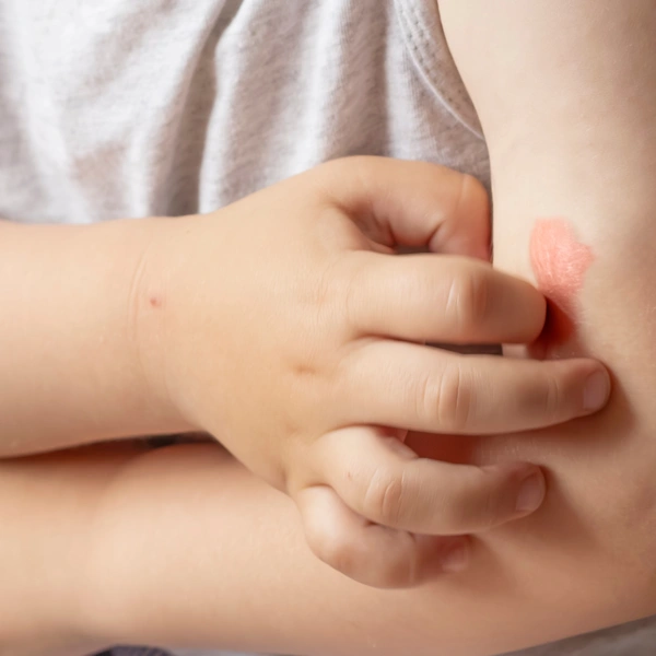 Niño con alergia